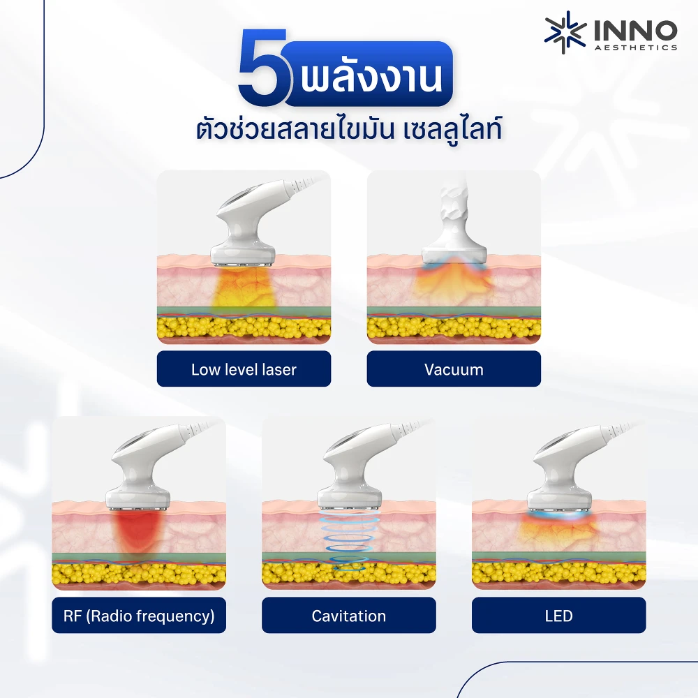 Aurora X2 เทคโนโลยี 5 พลังงานช่วยสลายไขมัน