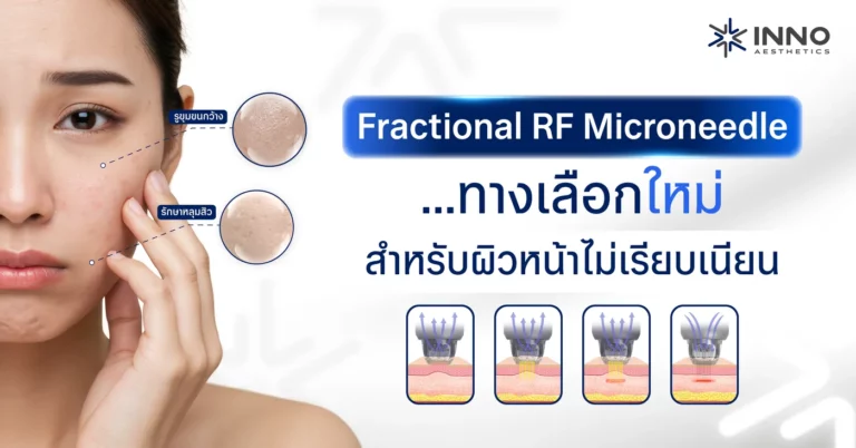 Fractional RF Microneedle ทางเลือกใหม่…สำหรับผิวหน้าไม่เรียบเนียน