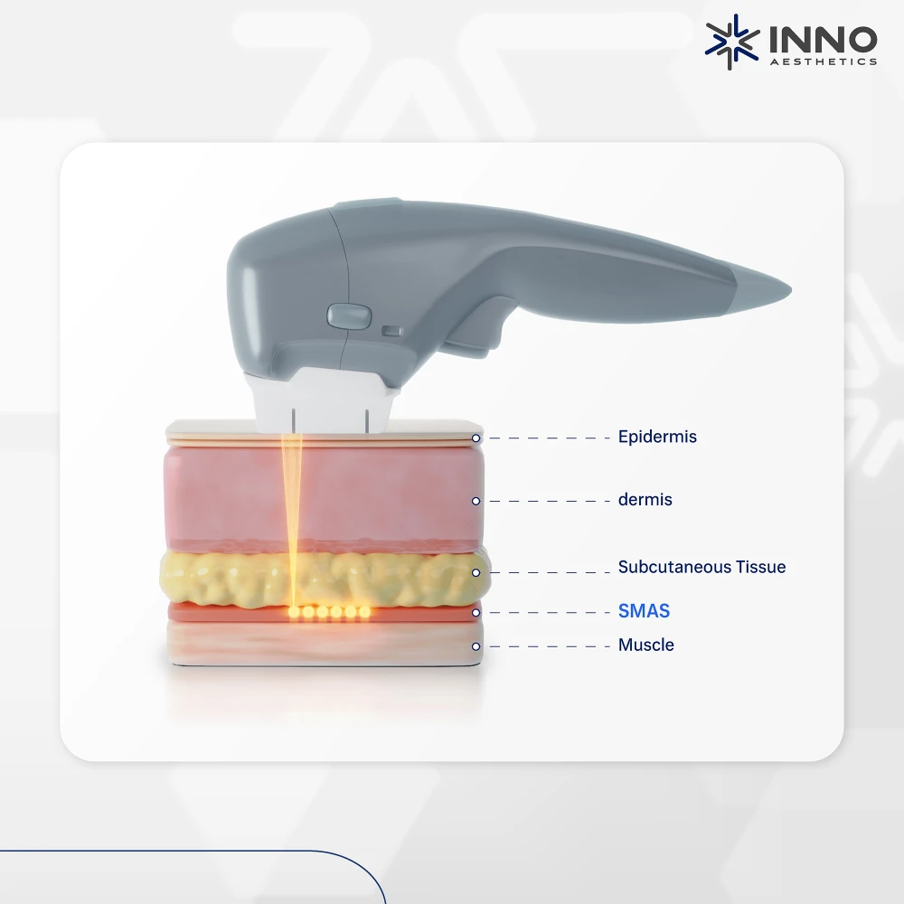 หลักการทำงานของ HIFU (ไฮฟู่)  Vsonic 7D