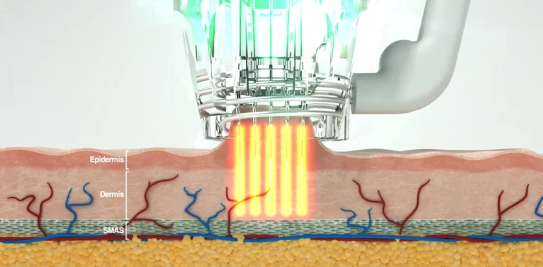 Focus-Daul_needle-INNO-IMG