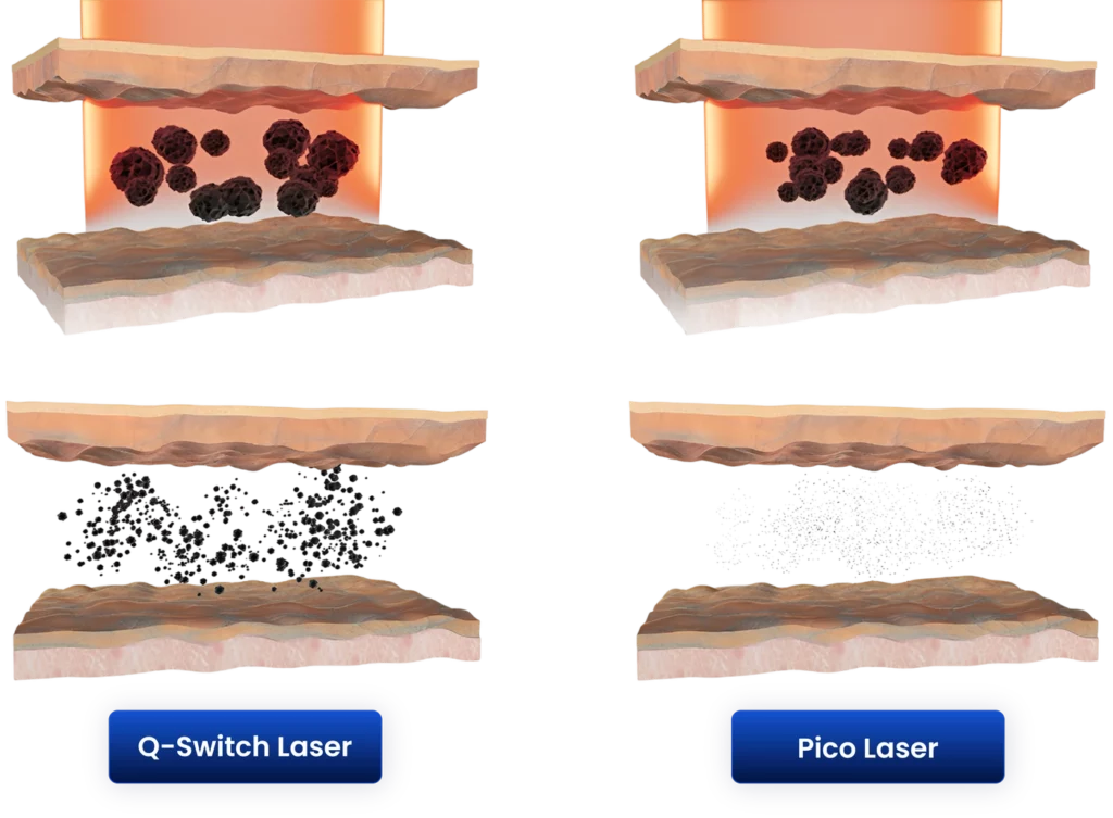 Pico Laser VS Q-Switched laser