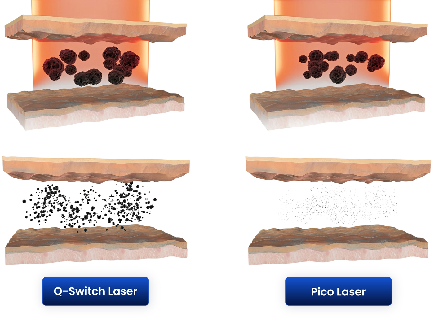PICO vs Q-Switch