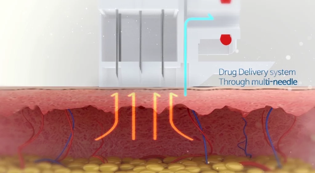 Technology Vital Injector