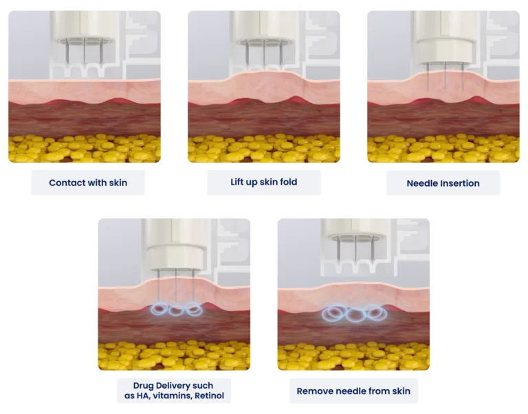 หลักการทำงาน Vital Injector 3