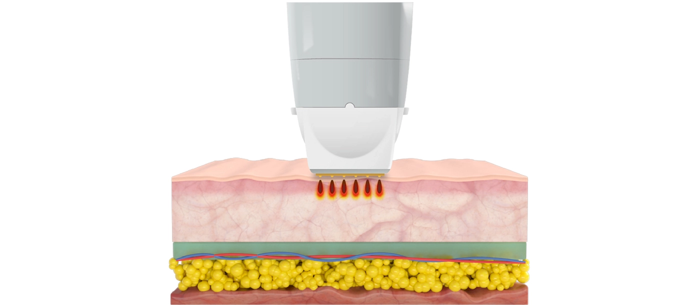 Fractional RF-INNO-IMG