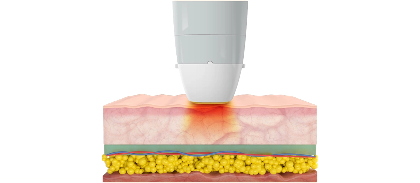Thermal RF n-INNO-IMG