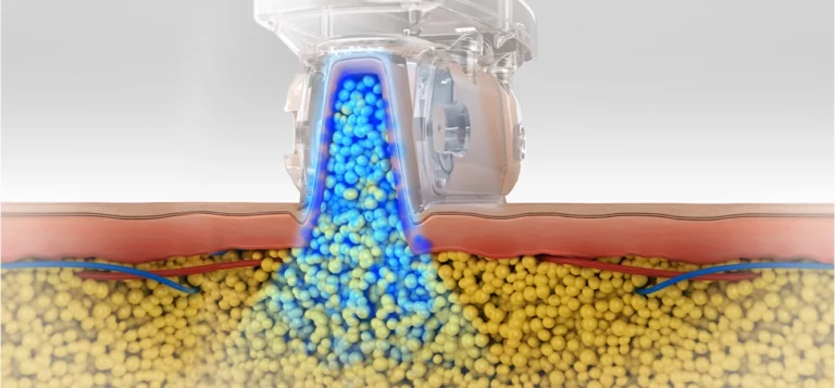 cryo_coolshaping1_tech_img-INNO-IMG