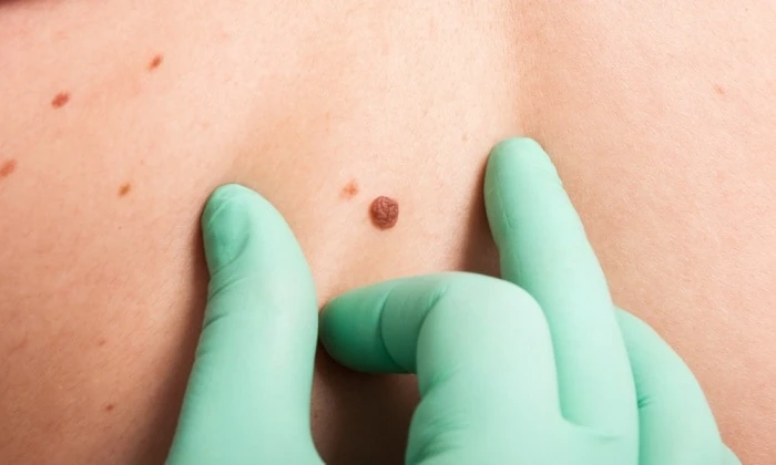 ไฝ คืออะไร?