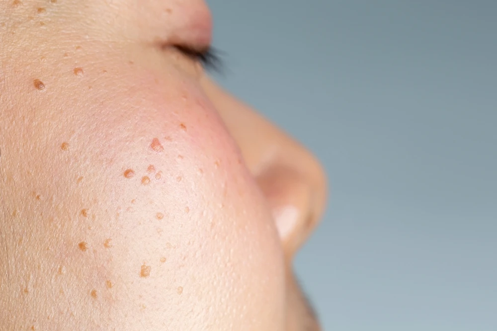 กระเนื้อ คืออะไร?