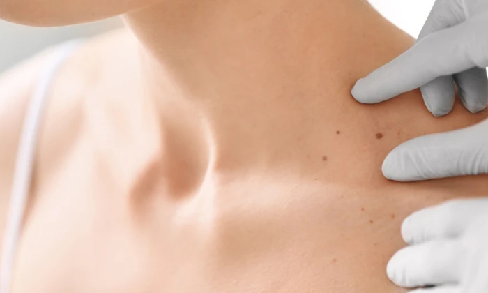 ขี้แมลงวัน คืออะไร ?