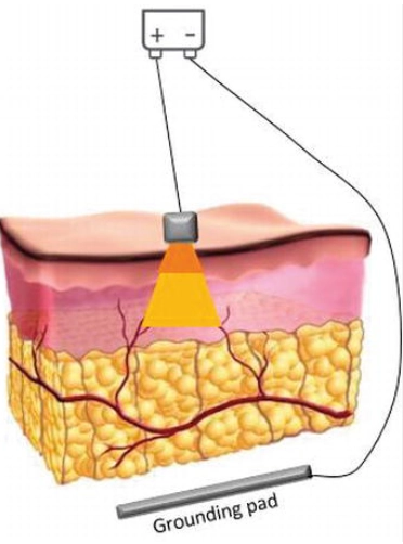 get-rid-of-cellulite-aurora-x2