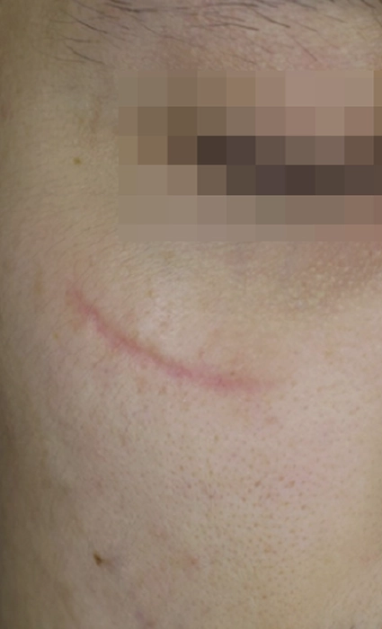 ก่อน 3BA Ultrascan-INNO-IMG