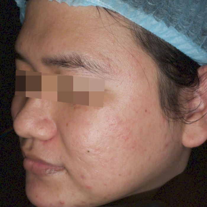 ก่อน3-BA carina-INNO-IMG