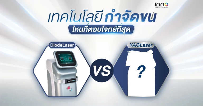 Diode Laser VS YAG Laser : เทคโนโลยีกำจัดขนไหน ที่ตอบโจทย์ที่สุด
