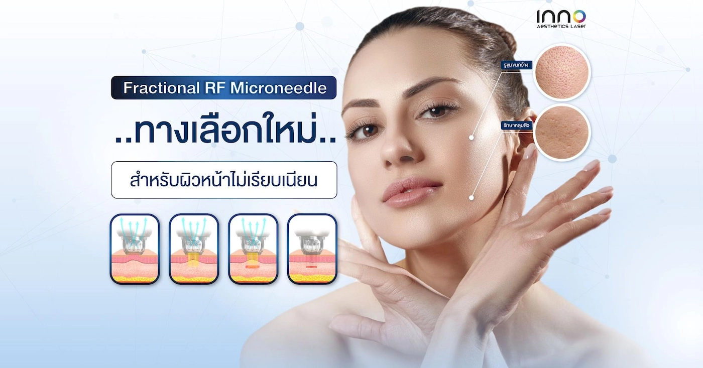 Fractional RF Microneedle ทางเลือกใหม่…สำหรับผิวหน้าไม่เรียบเนียน