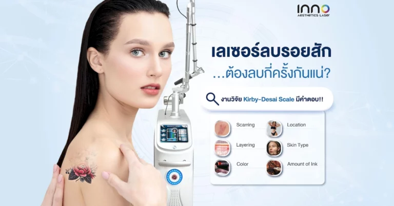 เลเซอร์ลบรอยสัก ต้องลบกี่ครั้งกันแน่? งานวิจัย Kirby-Desai Scale มีคำตอบ !!