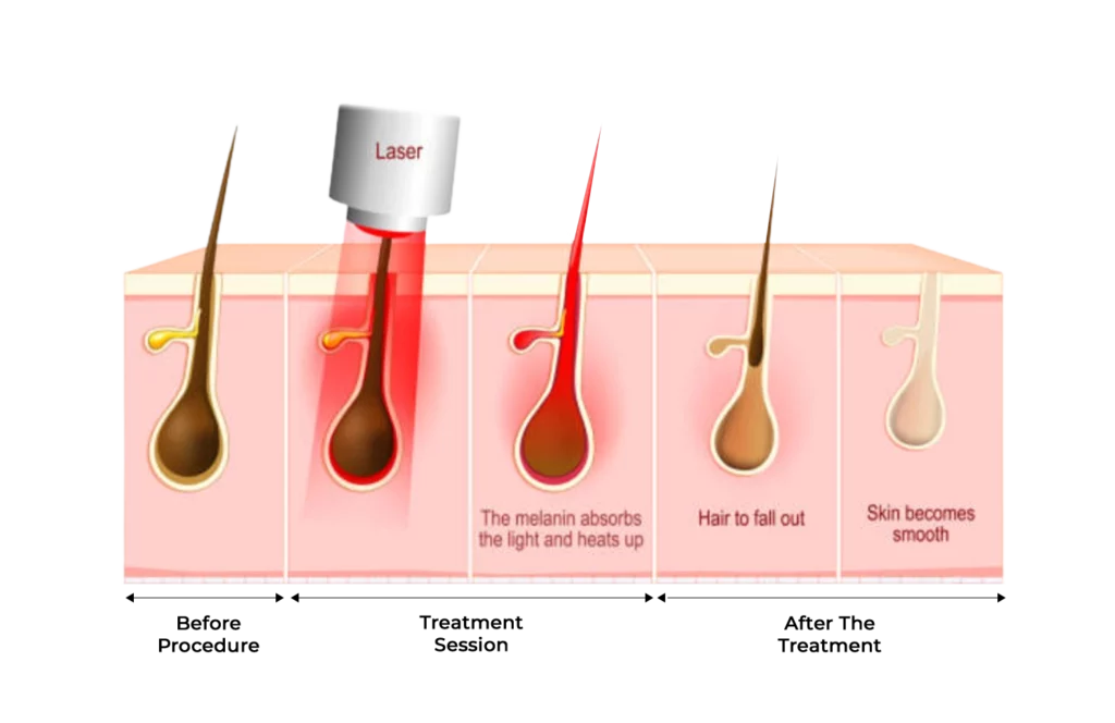 ประสิทธิภาพในการกำจัดขนของเครื่อง Diode Laser