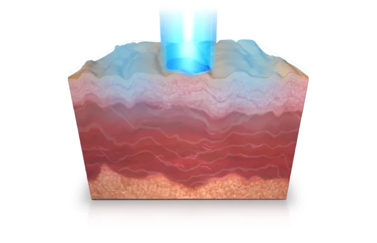 เครื่อง Pico Proteus Genesis Mode (Long Pulse)