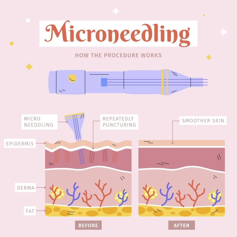 ไมโครนีดเดิล (microneedle) กับการประยุกต์ใช้ด้านความงาม