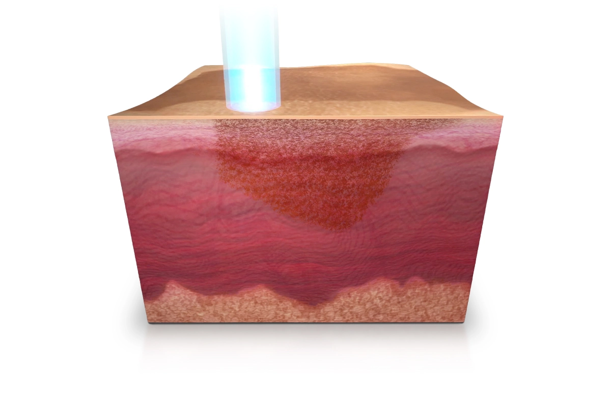 เครื่อง Pico Proteus PTP Mode (Double Pulse)