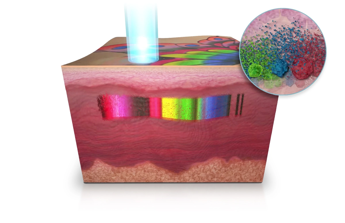 เครื่อง Pico Laser SP Mode (Single Pulse)