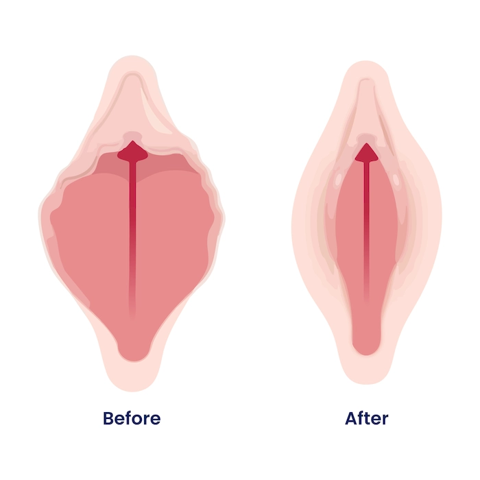 Lasena Gynecological BA 01