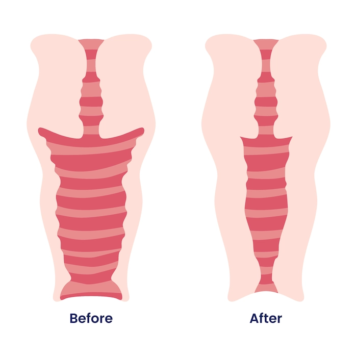 Lasena Gynecological BA 02