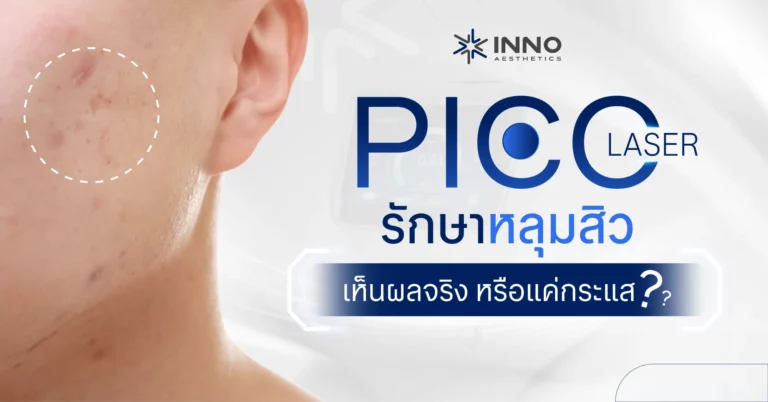 Pico Laser รักษาหลุมสิว เห็นผลจริงหรือแค่กระแส?