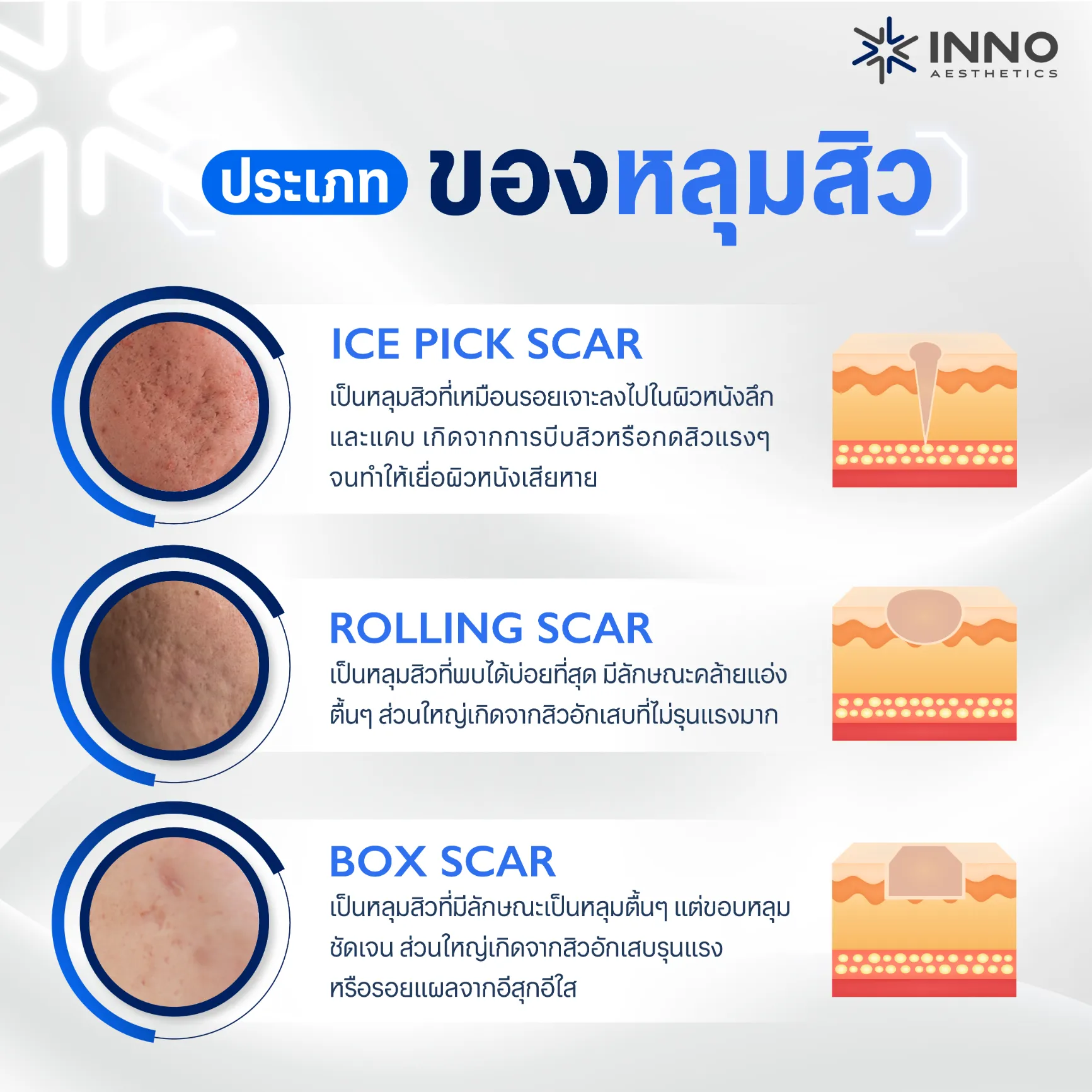 ประเภทของหลุมสิว