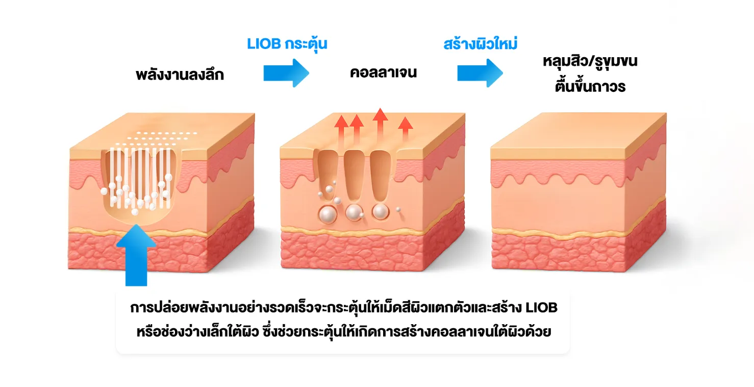 Pico Laser รักษาหลุมสิวได้อย่างไร ?