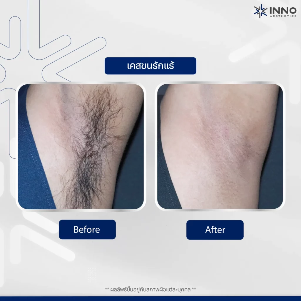 รีวิว เครื่อง Diode Laser