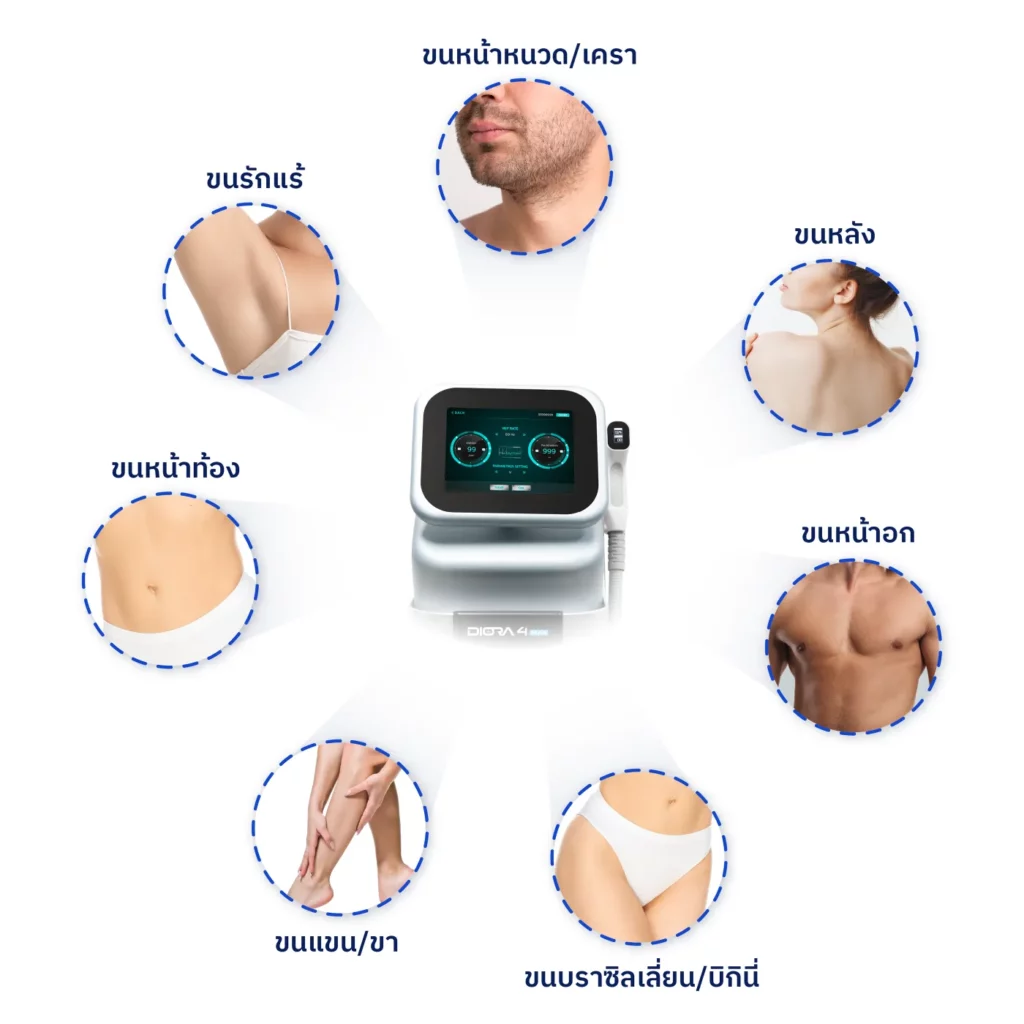 เลือกใช้ Diode Laser Diora 4Max บริเวณไหน