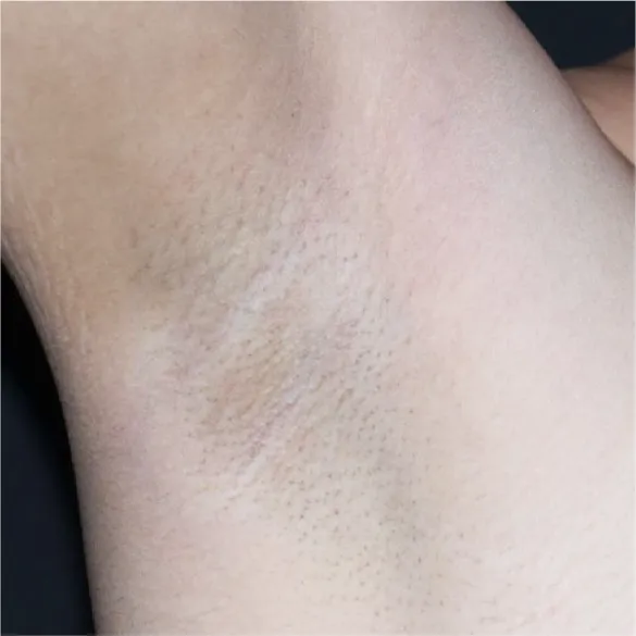 diod laser dolise after 04