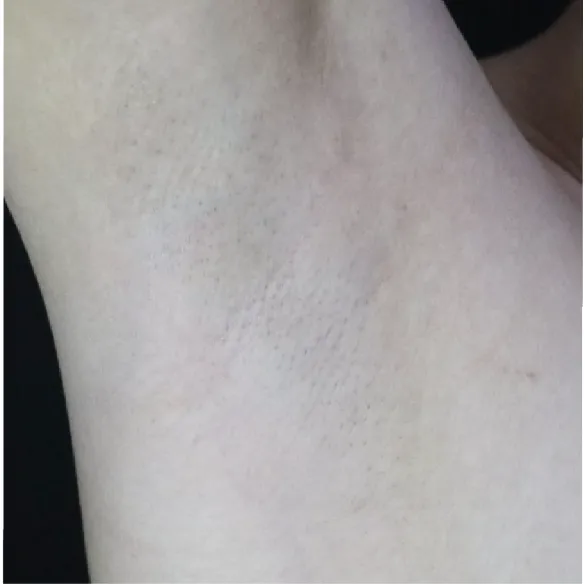 diod laser dolise after 03