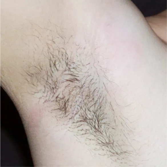 diod laser dolise before 04