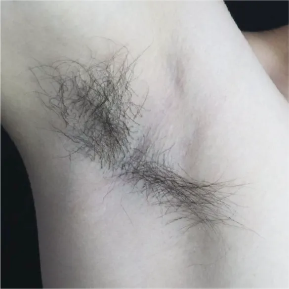 diod laser dolise before 03