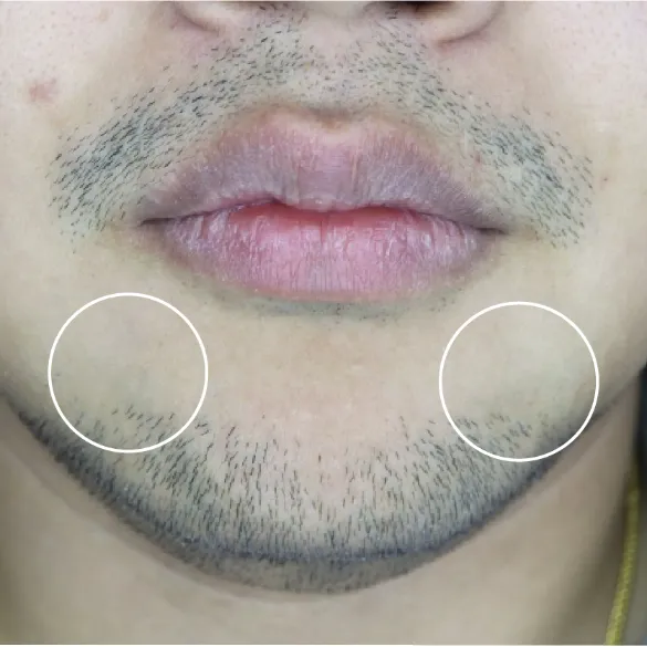 diod laser dolise after 02