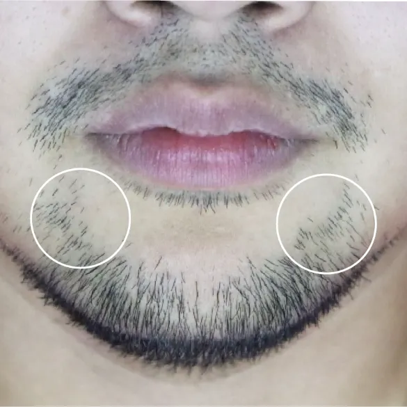 diod laser dolise before 02