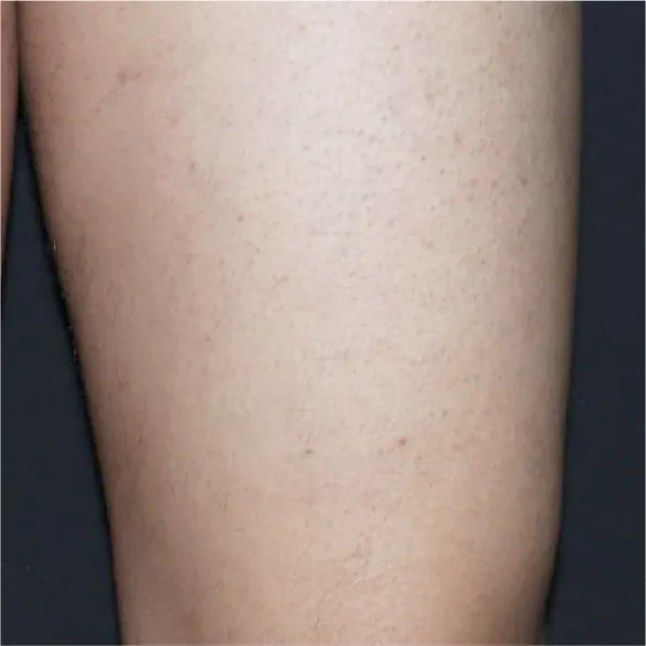 diod laser dolise after