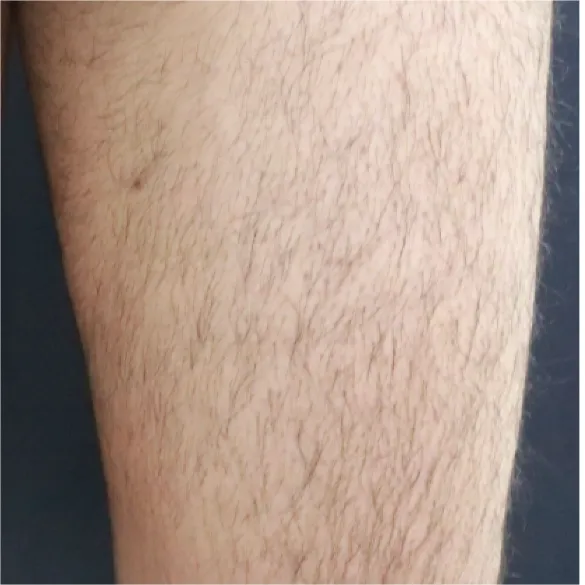 diod laser dolise before