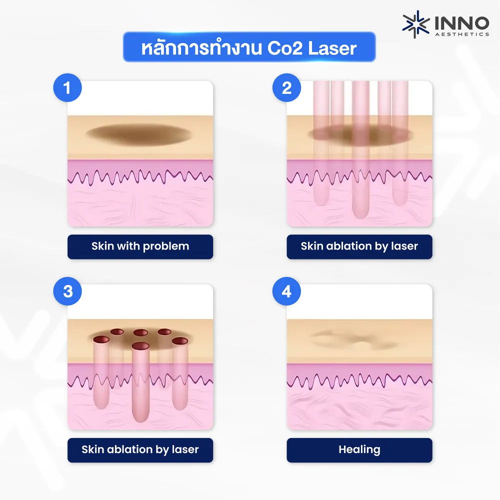 หลักการทำงาน Co2 Laser