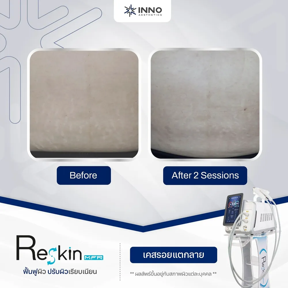 การกระตุ้นคอลลาเจนด้วยเครื่อง Microneedle RF