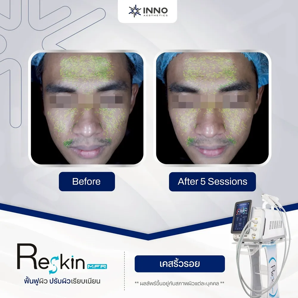 การกระตุ้นคอลลาเจนด้วยเครื่อง Microneedle RF