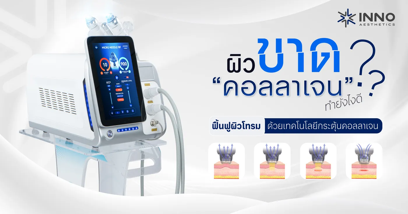 ผิวขาดคอลลาเจนทำยังไงดี? ฟื้นฟูผิวโทรมด้วยเทคโนโลยีกระตุ้นคอลลาเจน