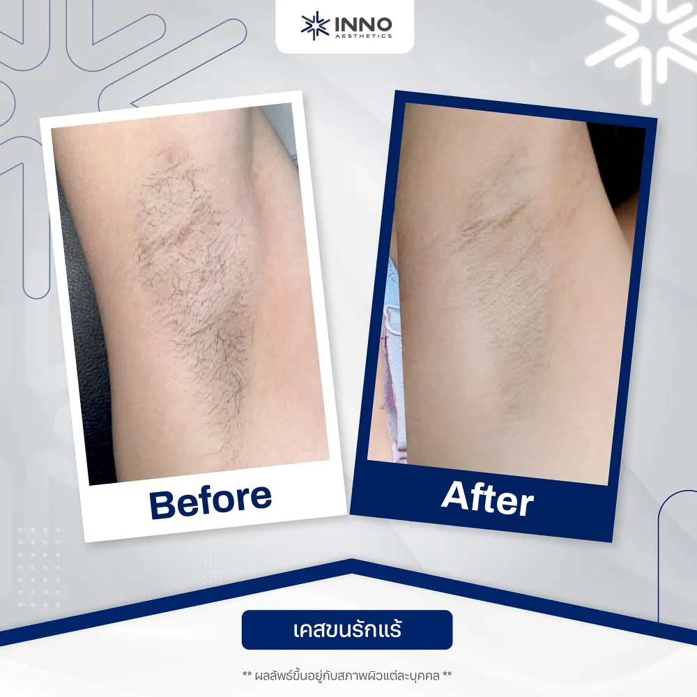 ผลลัพธ์ของเครื่อง diode laser Diora 4Max