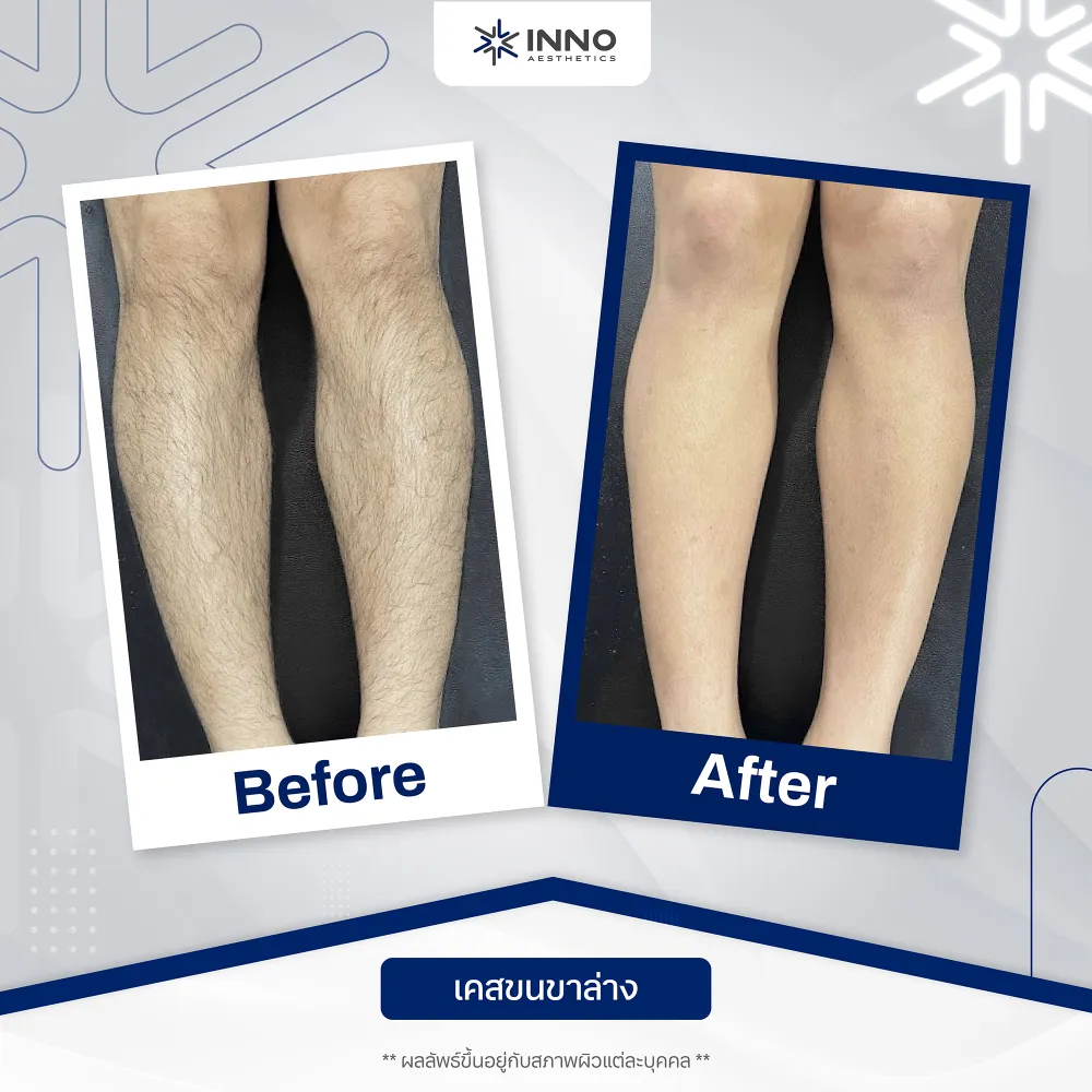 ผลลัพธ์ของเครื่อง diode laser Diora 4Max