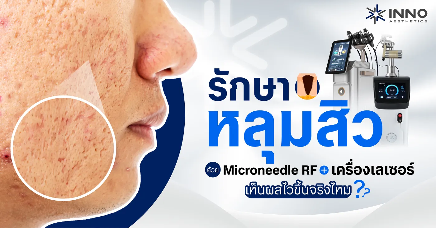 รักษาหลุมสิวด้วย Microneedle RF กับเครื่องเลเซอร์ เห็นผลไวขึ้นจริงไหม