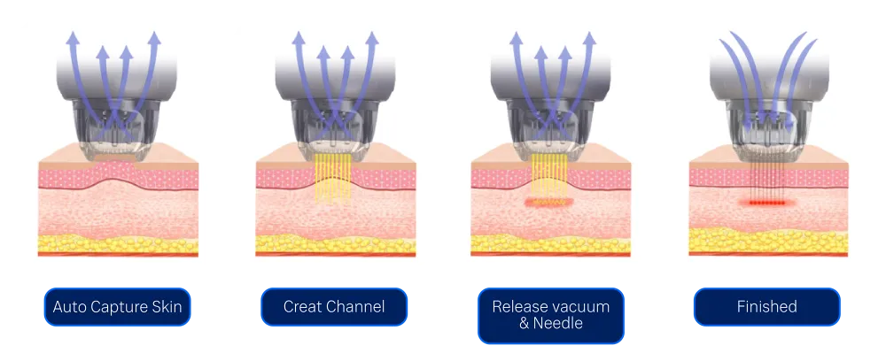 Microneedle RF ช่วยฟื้นฟูหลุมสิวอย่างไร