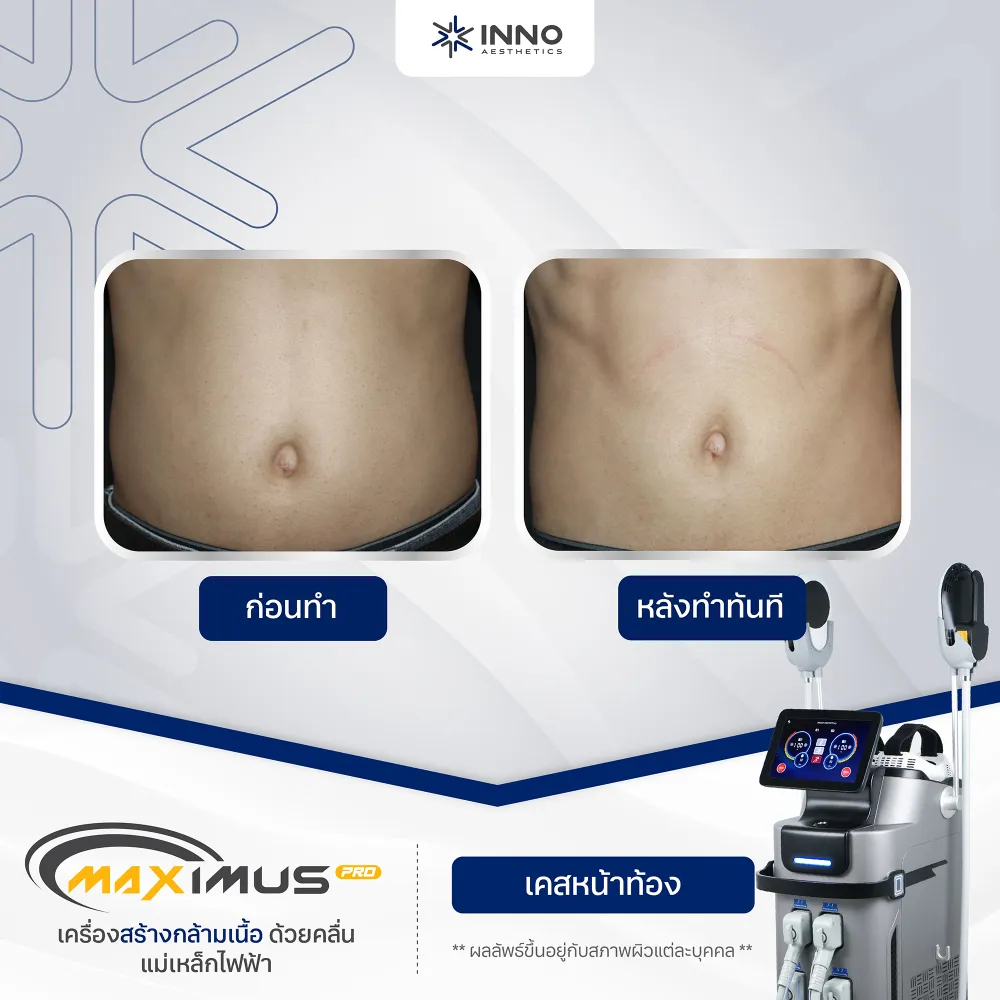 เครื่อง EMT ไม่ได้แทนการออกกำลังกาย แต่ช่วยเสริมผลลัพธ์ให้ตรงจุด