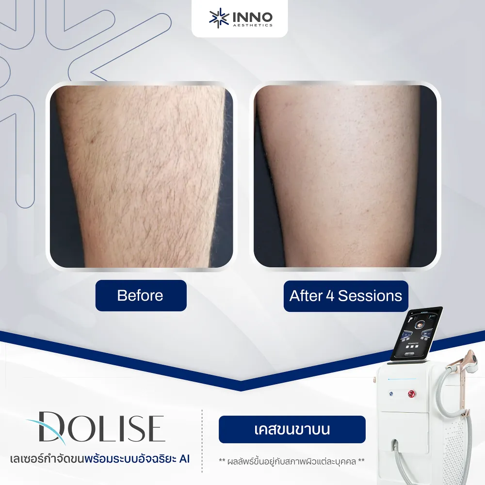 ผลลัพธ์หลังทำ "Dolise" Diode Laser